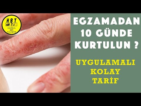 Egzama Nasıl Geçer Ellerdeki Egzamadan Kurtulmanın Kolay Tarifi Beyaz Dut Kurusu Kürü Tarifi