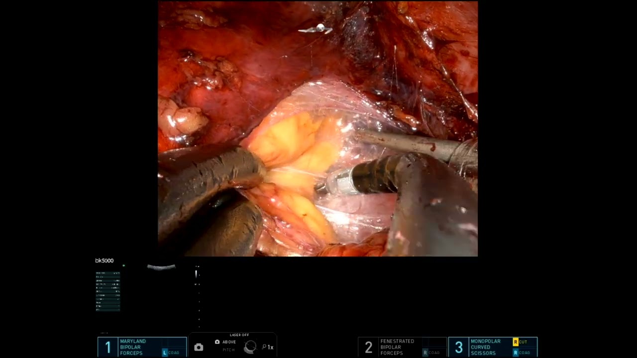 Single port retroperitoneal partial nephrectomy