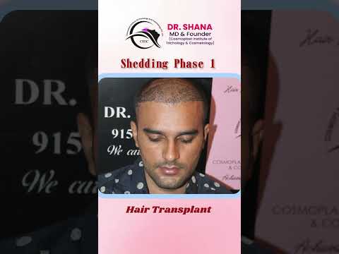 Hair Transplant Before After Citc Hairreplacementclinic Beforeandafter