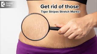 Ashamed of the tiger stripes stretch marks?| Stretch Marks Remedy |Dr. Rasya Dixit | Doctors' Circle