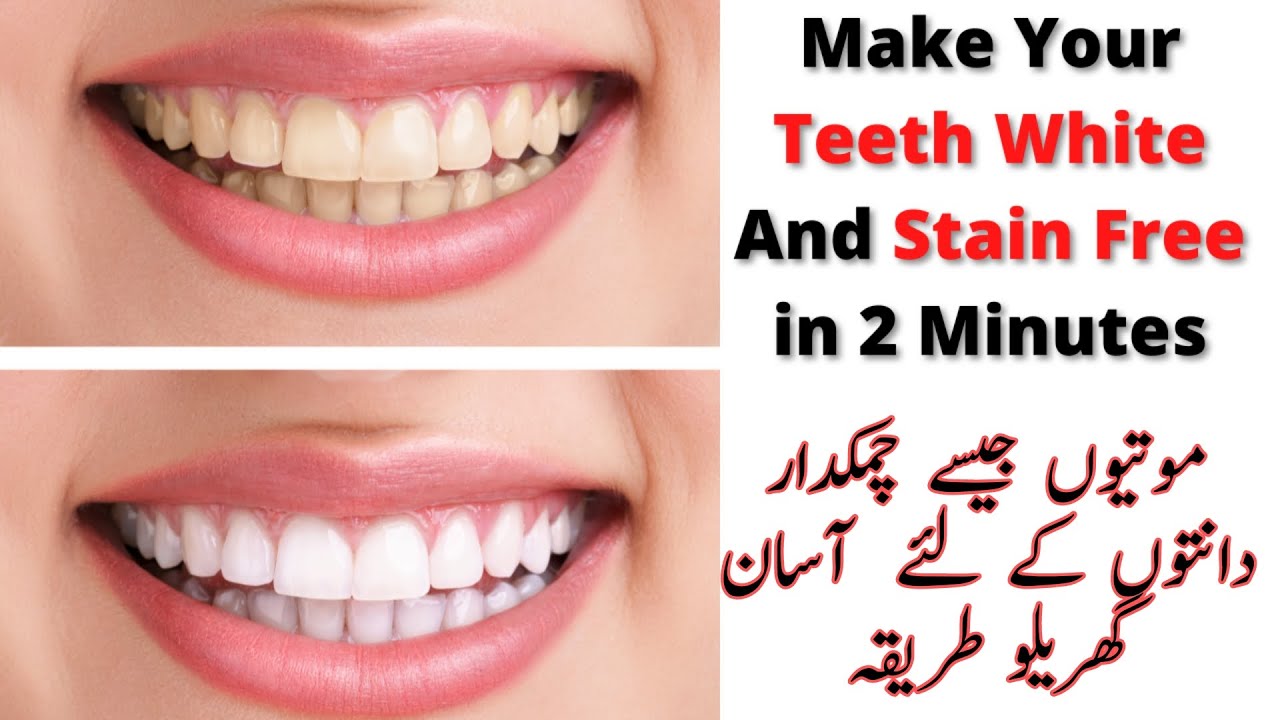 How To Remove Deep Stains From Teeth
