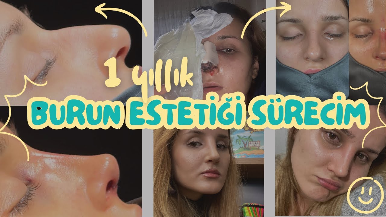 Devlet Hastanesinde 1 Yıllık Burun Ameliyatı Sürecim 👃Merak Ettikleriniz Soru-Cevap ❓#burunestetiği