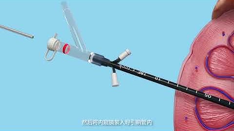 Vacuum Access Sheath Platform for higher clearance rate of stone fragments in PCNL and RIRS