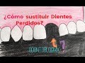 ¿Cómo sustituir dientes perdidos?