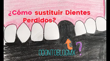 ¿Cómo se llama la sustitución de todos los dientes?