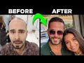 My Hair Transplant Journey 1 year later - BEFORE and AFTER (FUE)