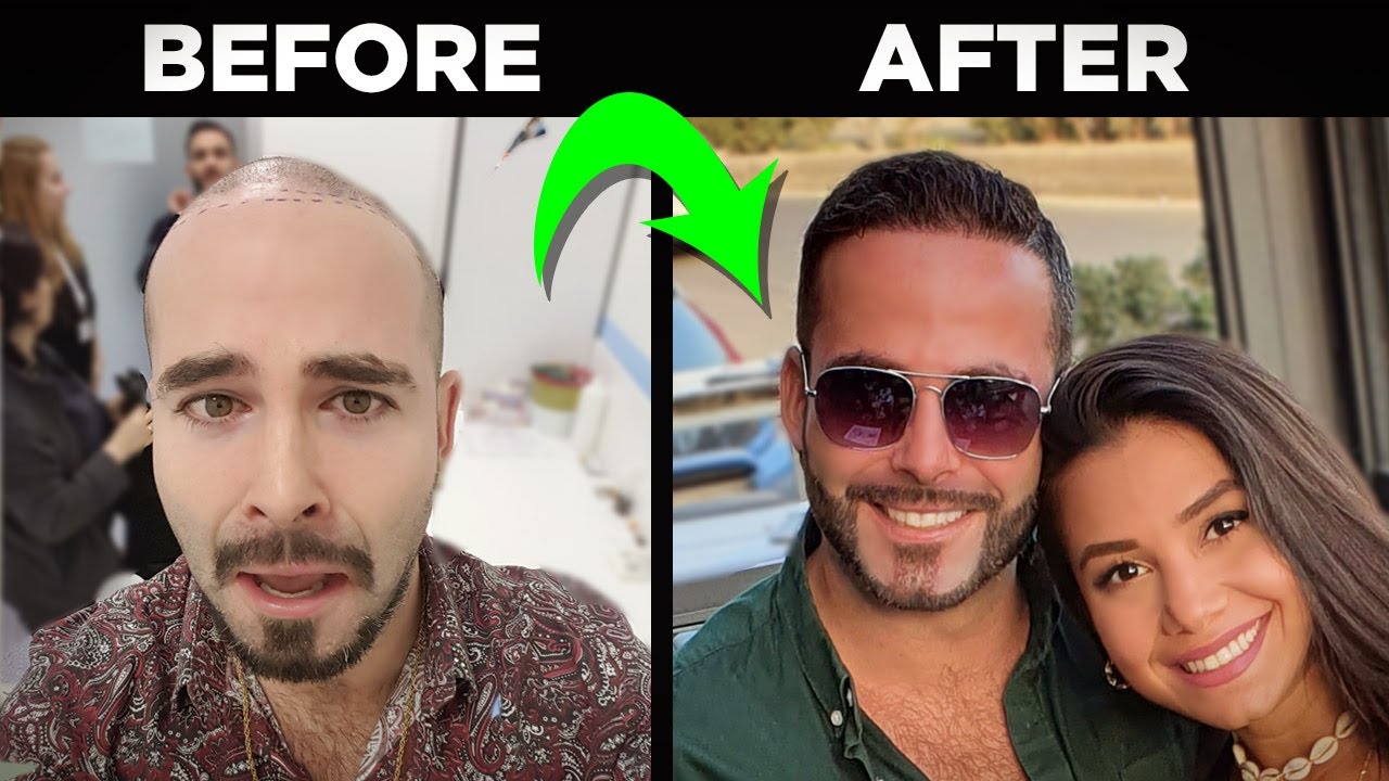 my hair transplant journey