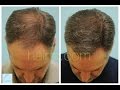 Dallas Hair Transplant Megasession Testimonial at 5 Months by Dr. Sam Lam