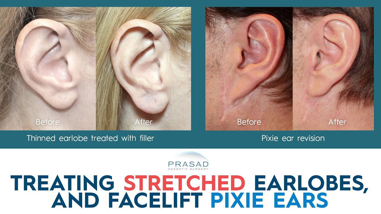 Ear & Earlobe Surgery  Visage Facial Plastic Surgery