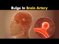 Cerebral Aneurysm | What Causes Bulge in Brain Artery? (Urdu/Hindi)