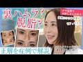 【実際にここまで変わる】目元設計のリアル症例紹介｜裏ハムラ・脱脂・モフィウス8を症例別に解説【LUX CLINIC 溝口順子】