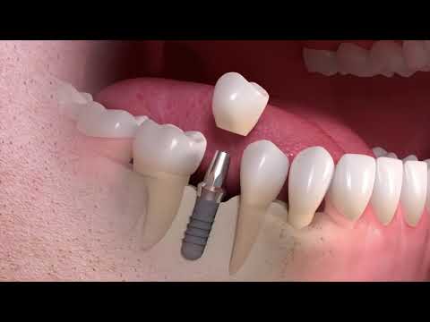 Vieno danties implantavimas - Straumann