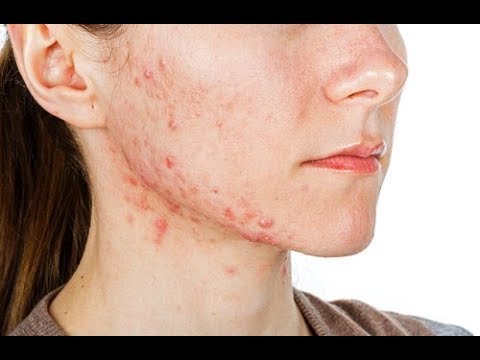 Video: 6 manieren om volwassen acne te behandelen