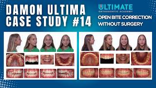 Open Bite Correction WITHOUT Surgery? | TAD Intrusion & LIFT Protocol (13-Month Case)