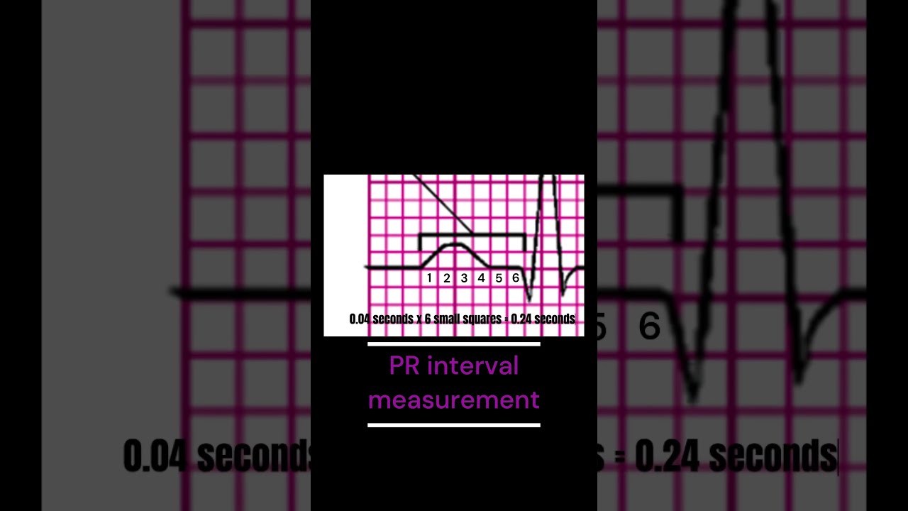 How to measure the PR interval