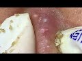 Satisfying Hien Spa Beauty Relaxing Video #12