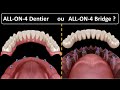 All on 4 - Type de prothèse :  Dentier ou Bridge ?