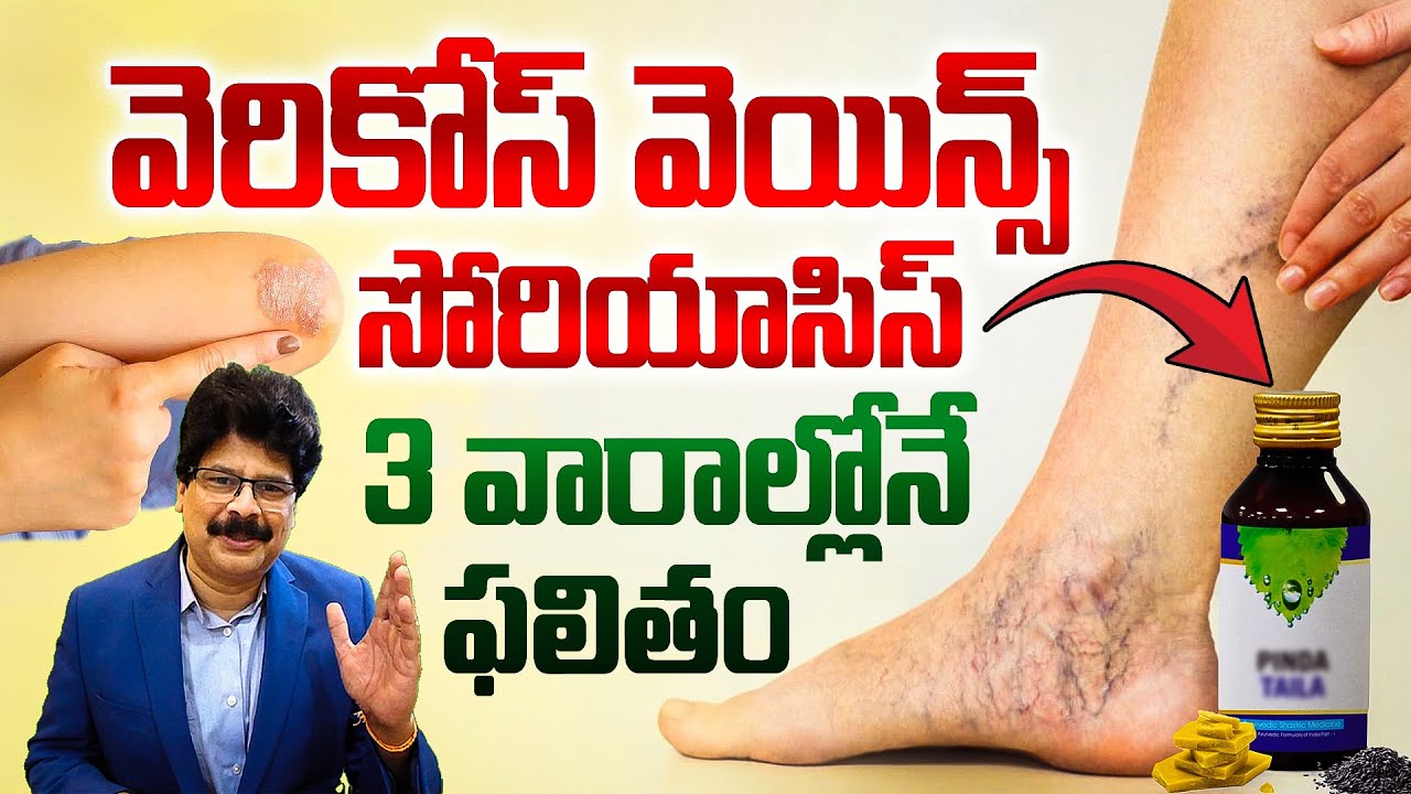 Permanent Cure for Varicose Veins & Psoriasis|వెరికోస్ వెయిన్స్, సోరియాసిస్ శాశ్వతంగా తగ్గే మెడిసిన్