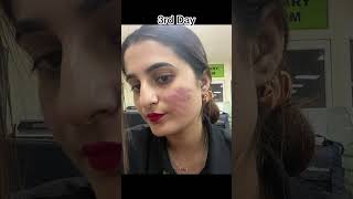 Day By Day Result Of 25%TCA Peel Application #skincare #skincareroutine #dermatologist #peeling