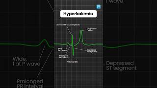 Hyperkalemia and Hypokalemia ECG changes