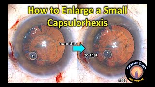 The secret to enlarge a small capsulorhexis