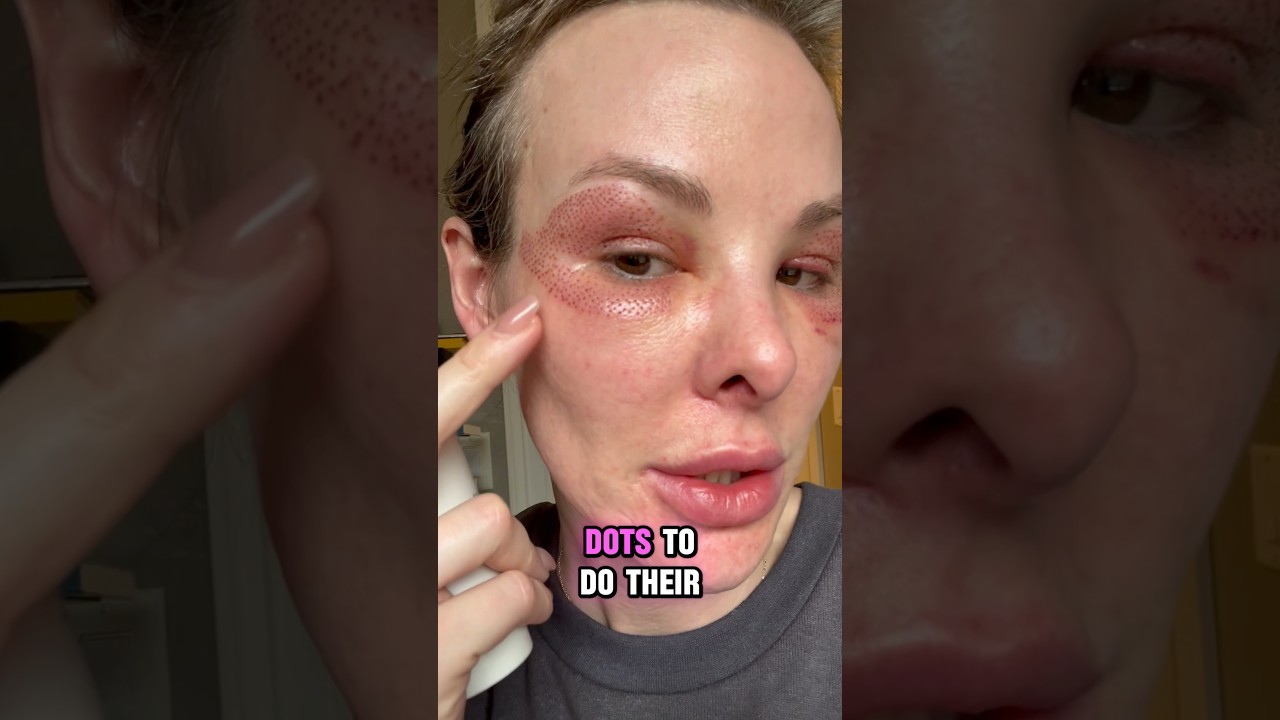 Заживление после 48 часов после плазменной ручки 🖊️