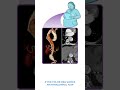 Diagnostics on Demand: Aortic dissection