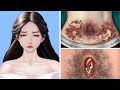 Asmr remove big acne  worm infected belly  deep cleaning animation