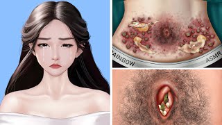 ASMR Remove Big Acne \& Worm Infected Belly | Deep Cleaning Animation