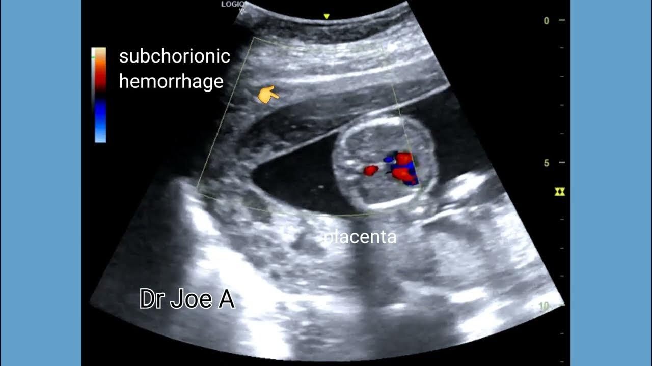 Subchorionic Hemorrhage And Hematoma In 2nd Trimester Pregnancy
