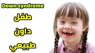 علامات الطفل المنغولى ( متلازمة داون ) كيفية تحديد الطفل الداون و ما هى اسباب حدوثه و كيفية علاجه