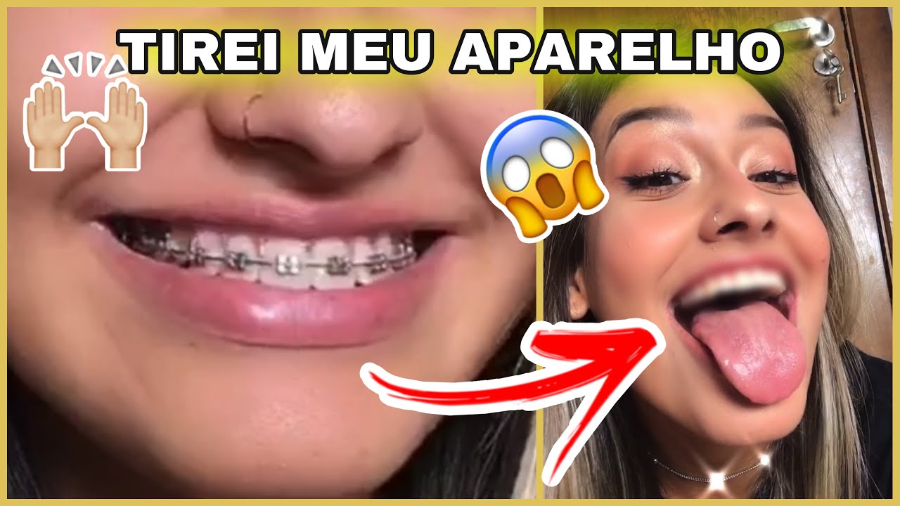 TIREI MEU APARELHO DEPOIS DE 7 ANOS