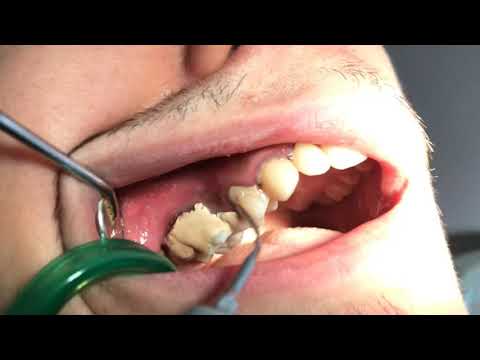 Video: Anestezisiz Diş Temizleme