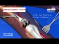 Knee replacement surgery in desun hospital kolkata