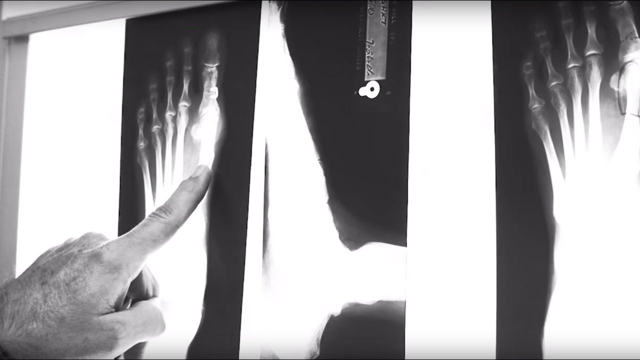 O. Christian Hall, D.P.M. Bone & Joint Clinic of Baton Rouge YouTube