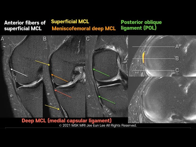 Medial Collateral Ligament Of The Knee - Everything You Need To Know - Dr.  Nabil Ebraheim 