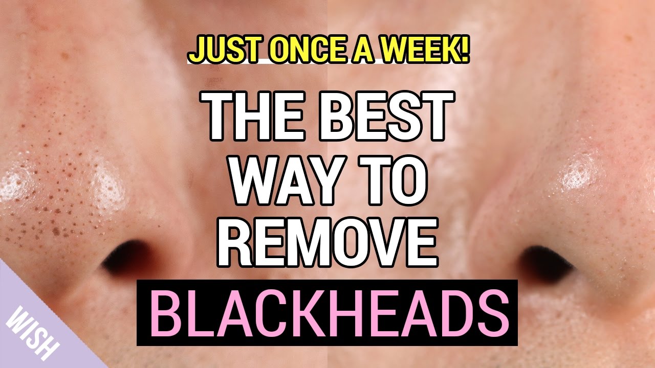 blackhead removal