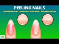 Understanding Peeling Nails: What Your Nails are Trying to Tell You