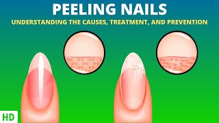 Understanding Peeling Nails: What Your Nails are Trying to Tell You