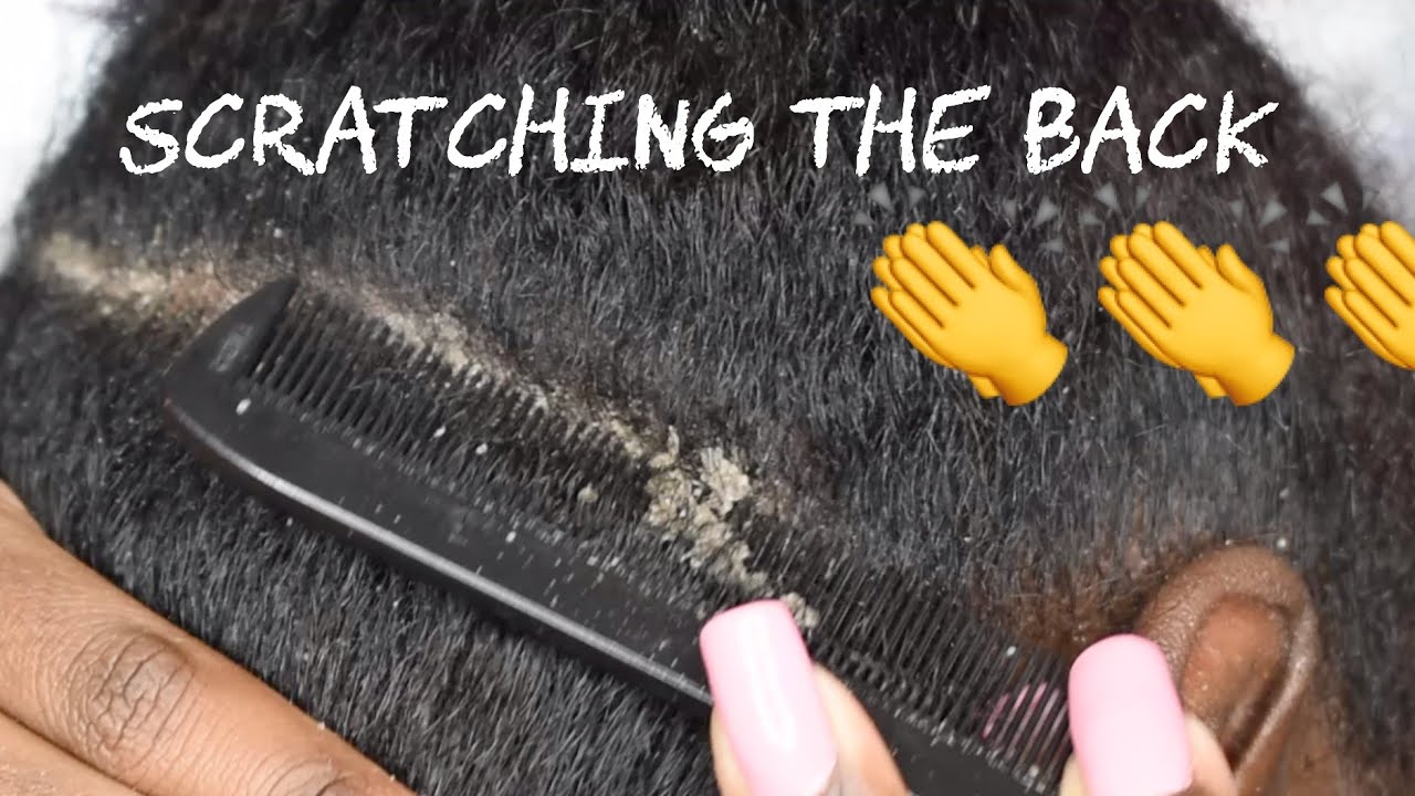 HUGE FLAKES | DRY FLAKY SCALP | DANDRUFF SCRATCHING Ep17 part2 