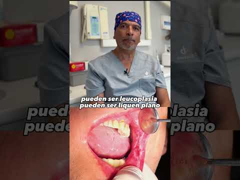 Lesiones orales 👉🏻 todo lo que tienes que saber #dentista #lesionesorales
