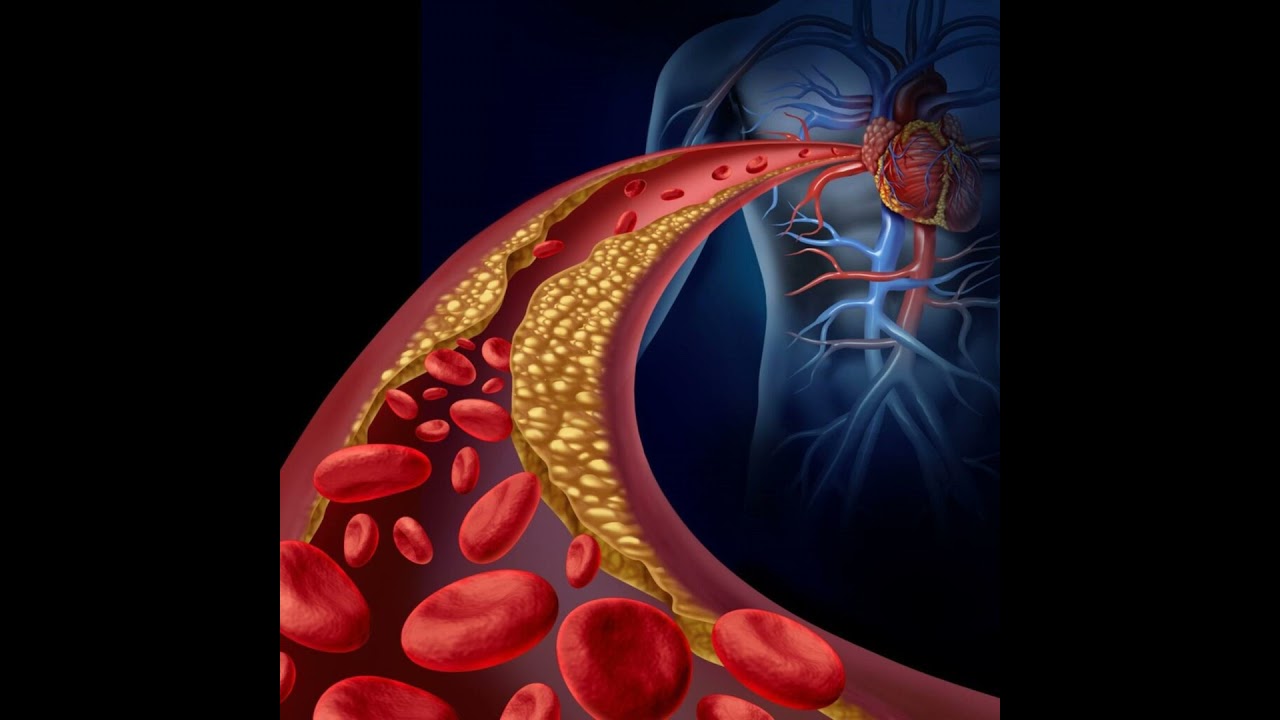 Food Flags: What NOT to Eat for Healthy Cholesterol