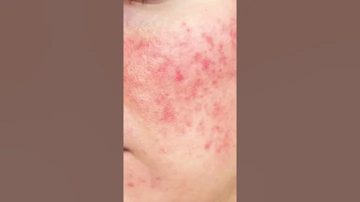 Rapid Tea Tree  Oil Hack-Home Scar Removal #shorts#teatreeoil