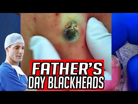 father's-day-blackheads!-dilated-pores-&-blackhead-masks-for-dad