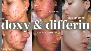 How To Get Clear Skin With Doxy And Differin With Results How I Cleared My Skin In 3 Months