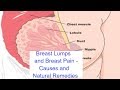 Breast Lumps and Breast Pain – Causes and Natural Remedies