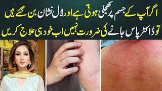 Jism Par Kharish Kyu hoti Hai | Psoriasis Treatment In Urdu - Chambal Ka Ilaj  | Dr Sahar Chawla