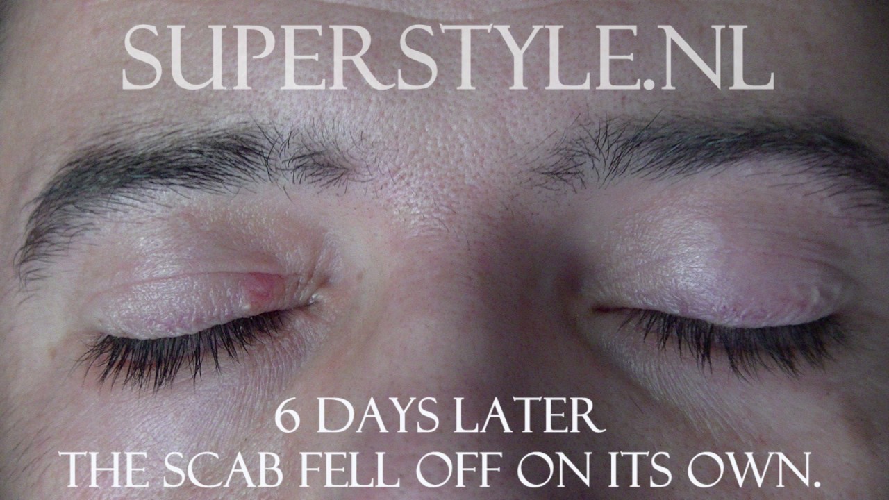 Benign eyelid lesion removal super style youtube Stue skab