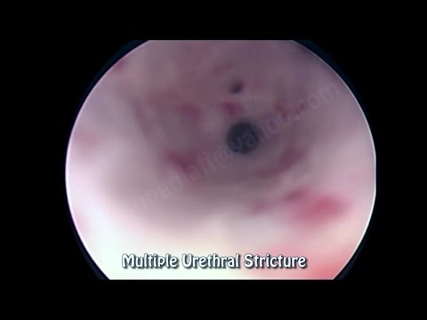 Long Stricture Urethra Cure By Memokath Urethral Stent