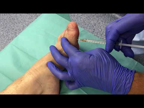 Анестезия по Оберсту-Лукашевичу при вросшем ногте. Anesthesia (Ingrown toenail).